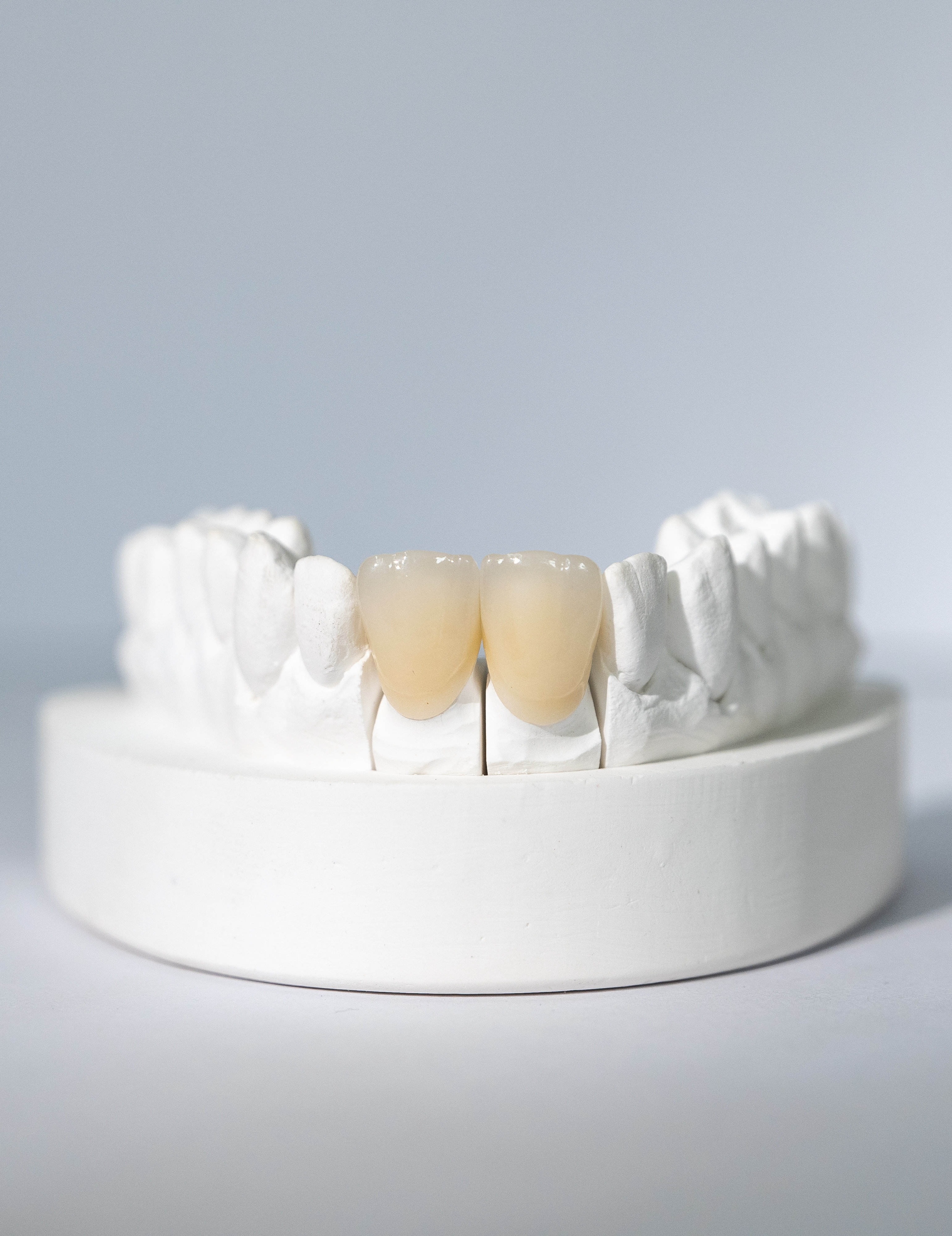 Full Contour Zirconia