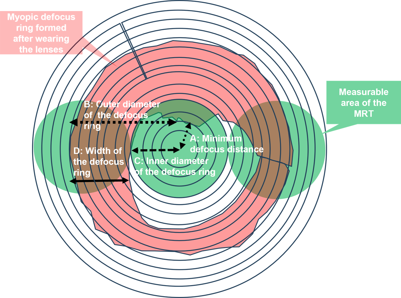 Refraction Topography detection OK Lens's defcous range and parameter diagram.