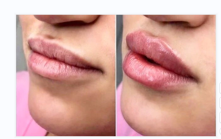 lipfiller