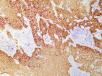 IHC-双染-肺鳞癌--CK56--R--hrp--ki67-M--AP--2