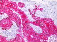 IHC-双染肺鳞癌-CK56-M-AP------Ki67-R--hrp--2