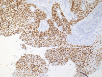 IHC-肺鳞癌---P63---M--
