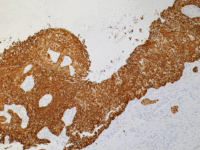 IHC-肺鳞癌--CK56-R