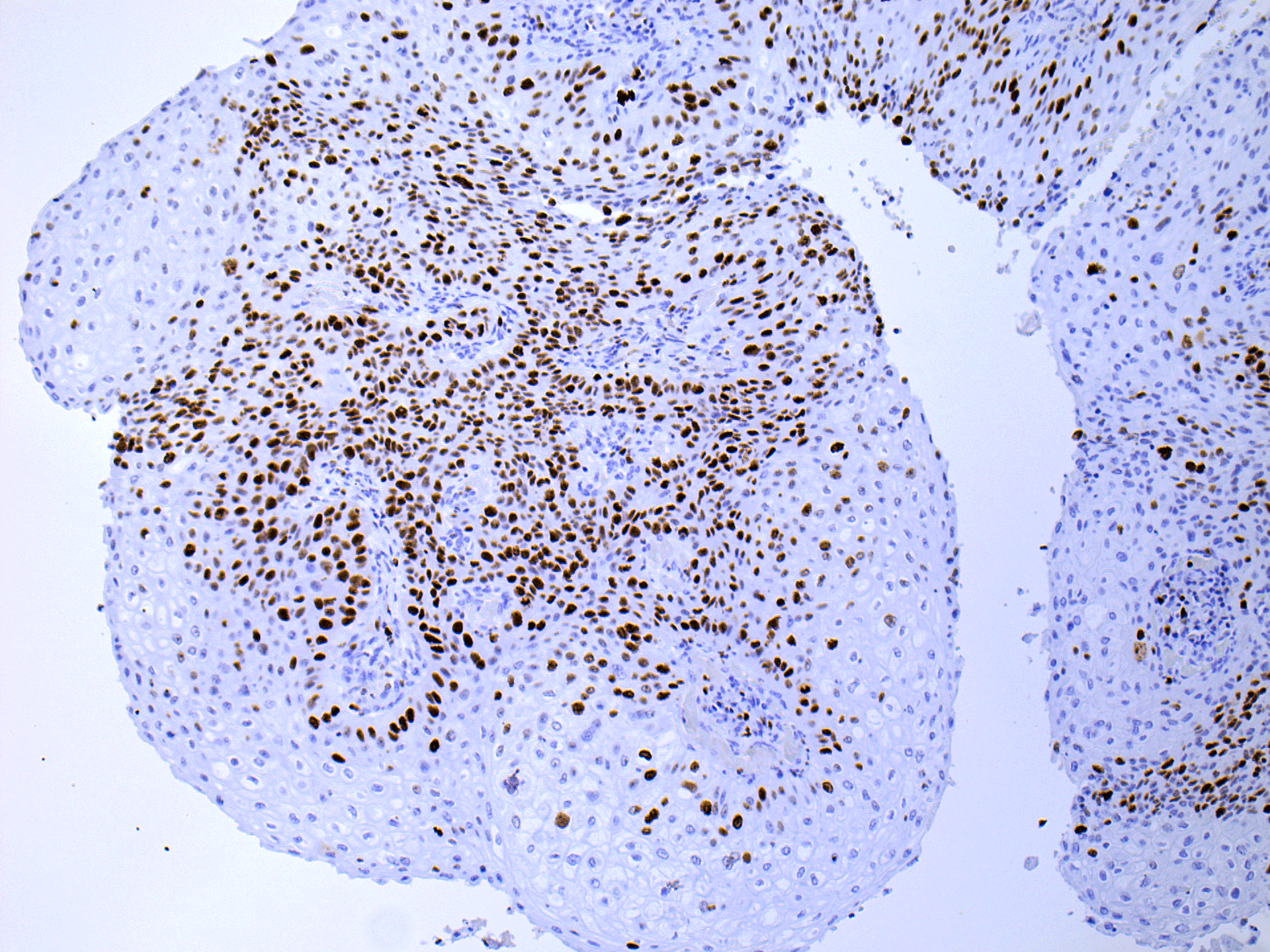 IHC-肺鳞癌-ki67-M---生物素-G-M--链霉亲和素-HRP--1