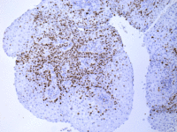 IHC-肺鳞癌-ki67-M---生物素-G-M--链霉亲和素-HRP--1